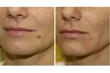 Ben Tedavisi Lazer Ben Tedavisi Lazer