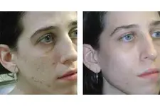 Fraksiyonel Lazer Tedavisi