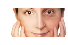 Lazer ile Leke Tedavisi Lazer ile Leke Tedavisi