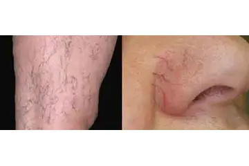 Kılcal Damar Lazer Tedavisi