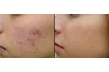 Lazer ile Sivilce İzi Tedavisi