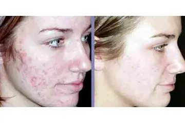 Sivilce Lazer Tedavisi